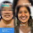 😁 Brackets en Trujillo: ¡Mejora tu sonrisa con Clínica NUDENT!